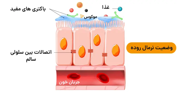 نشتی روده
