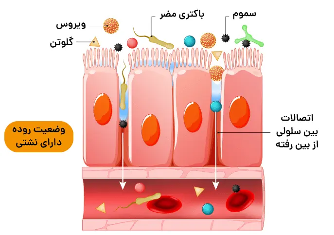 نشتی روده