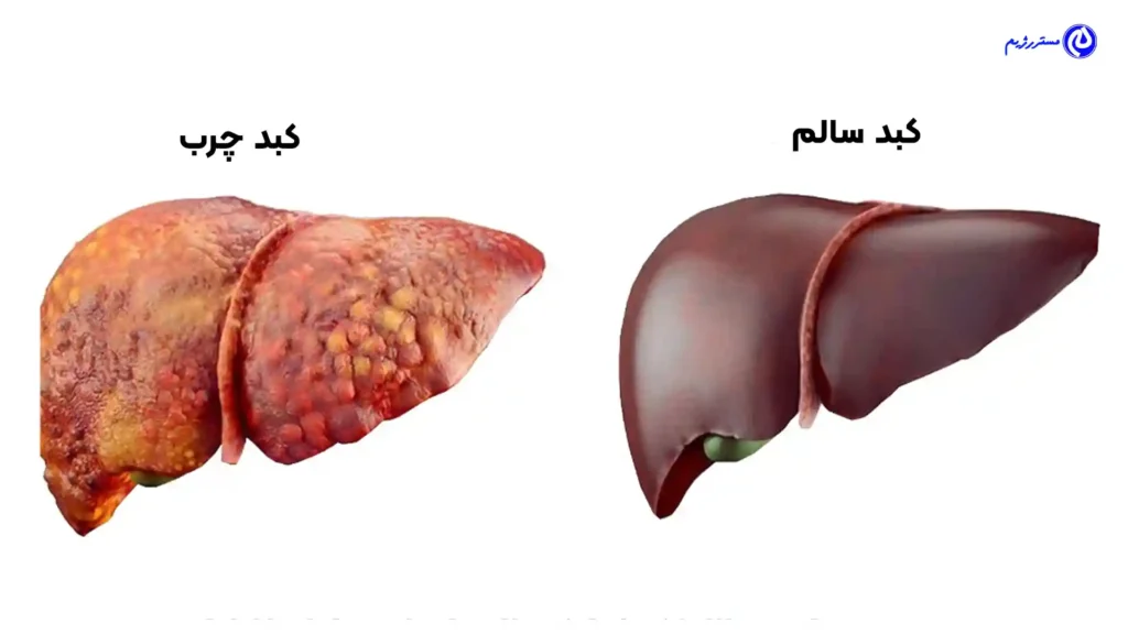 تفاوت کبد چرب و کبد سالم