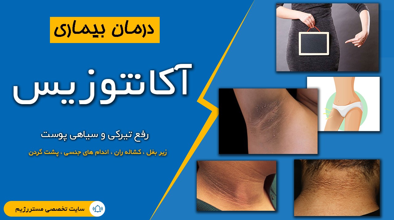 بیماری آکانتوزیس یا سیاهی نواحی از بدن