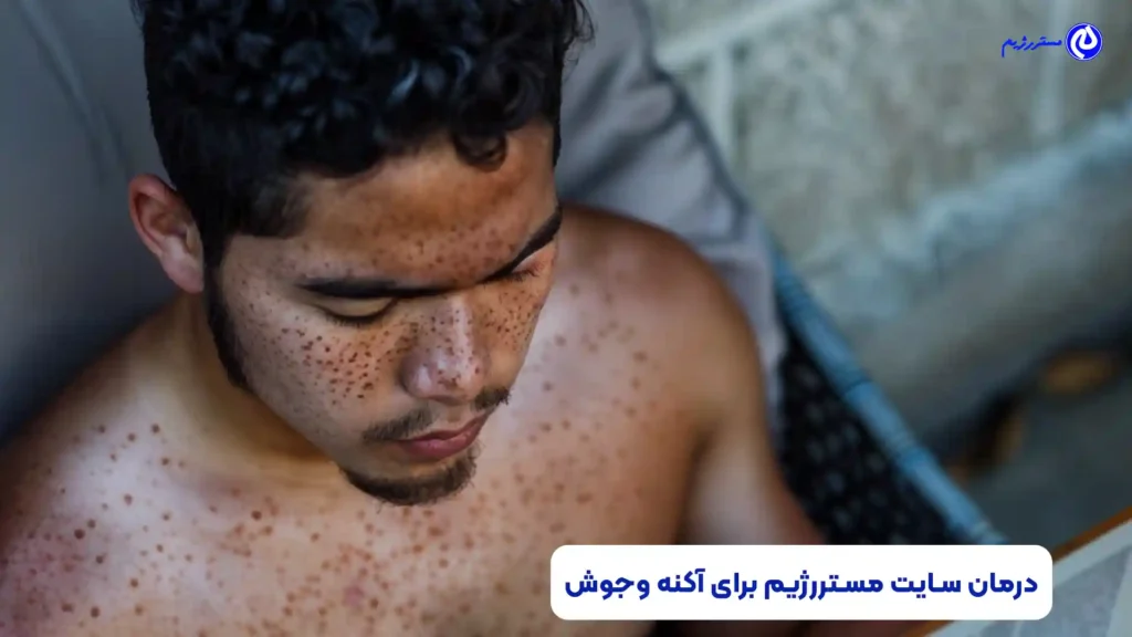 صورت و بدن پسری پر از جوش و آکنه