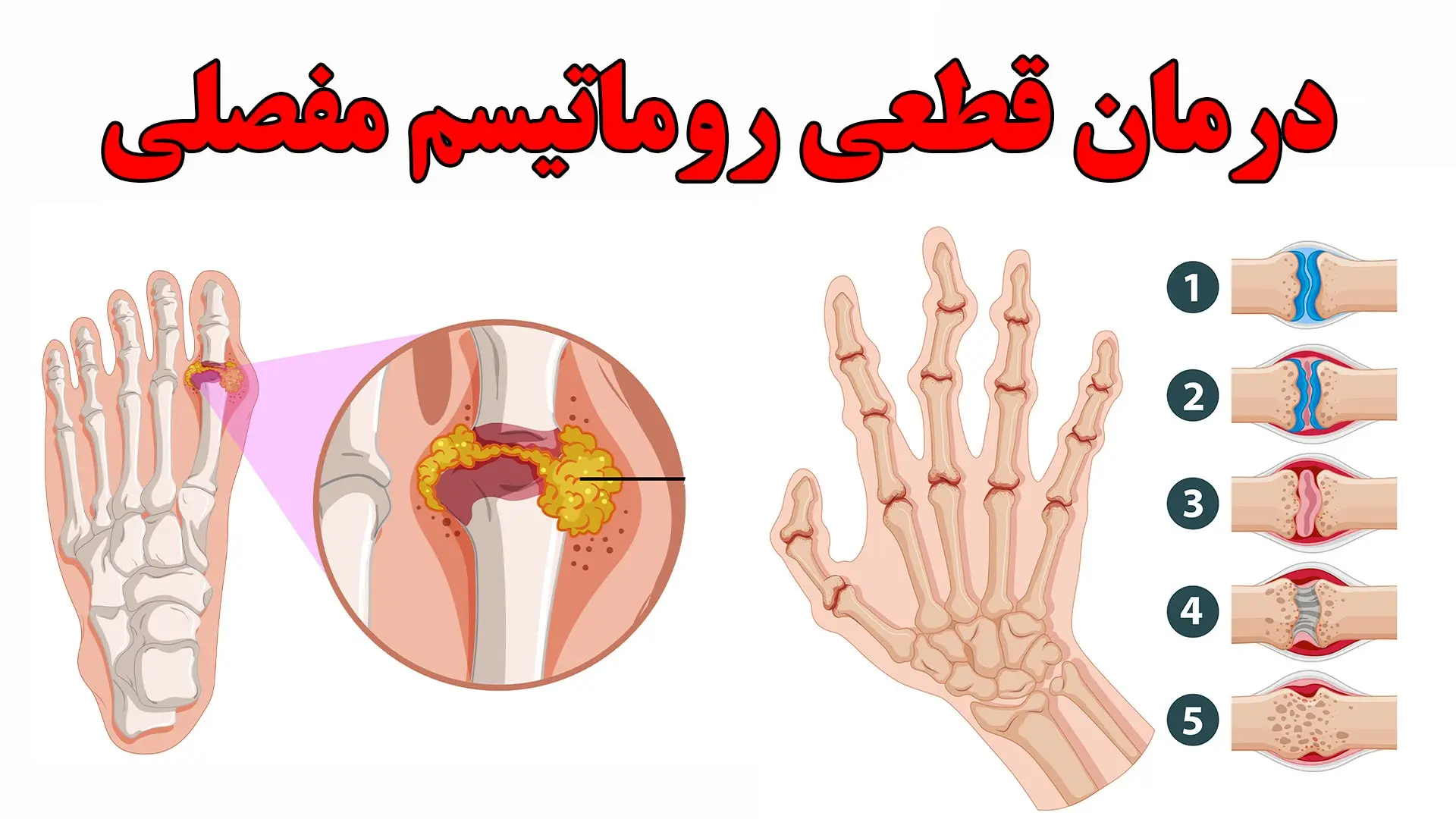 درمان روماتیسم مفصلی