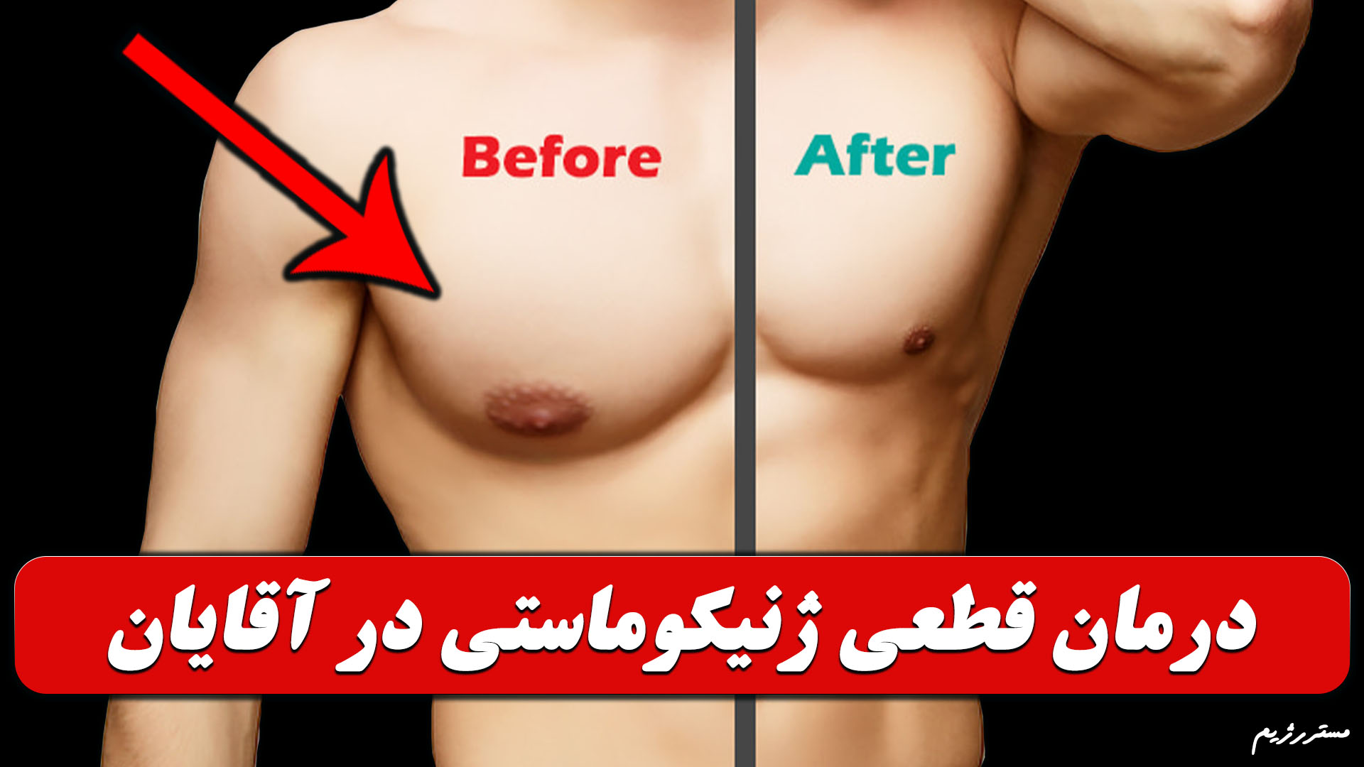 درمان ژنیکوماستی