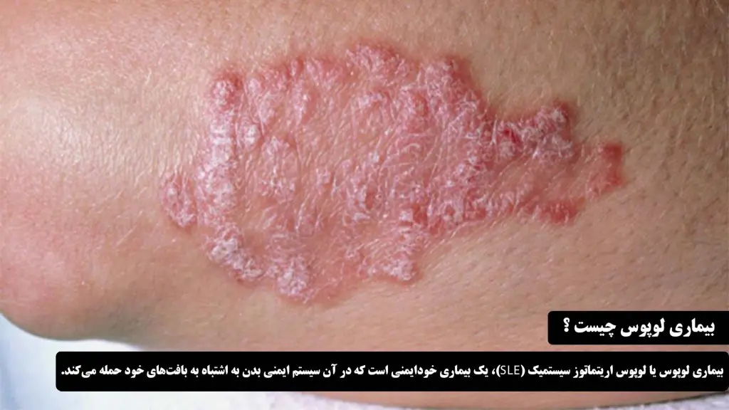 بیماری لوپوس چیست