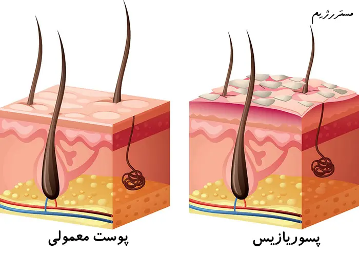 تفاوت پوست معمولی و پسوریازیس