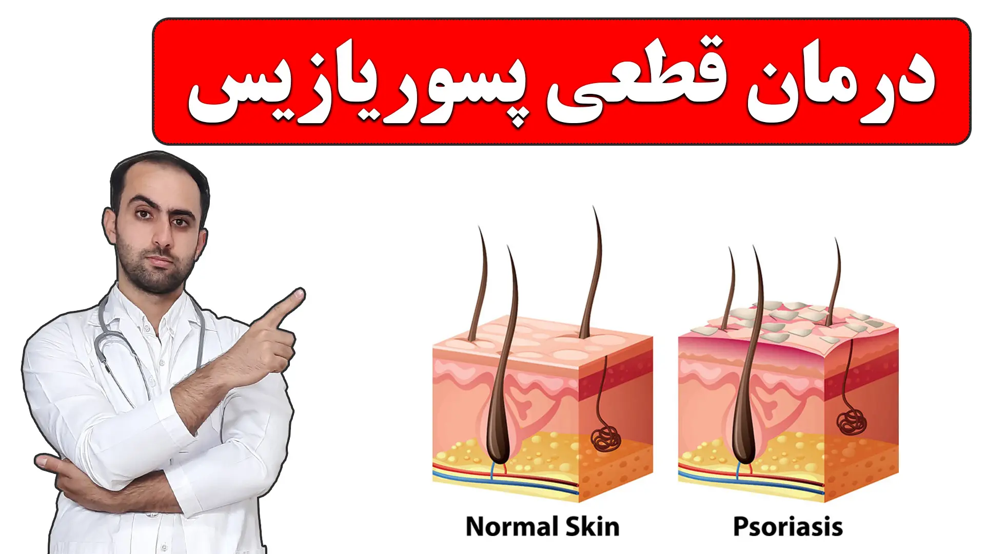 درمان پسوریازیس