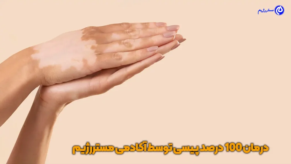 تصویر دستی که دچار پیسی شده