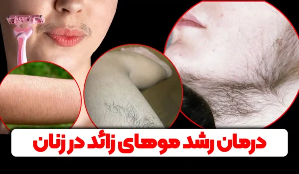 درمان موهای زائد در زنان