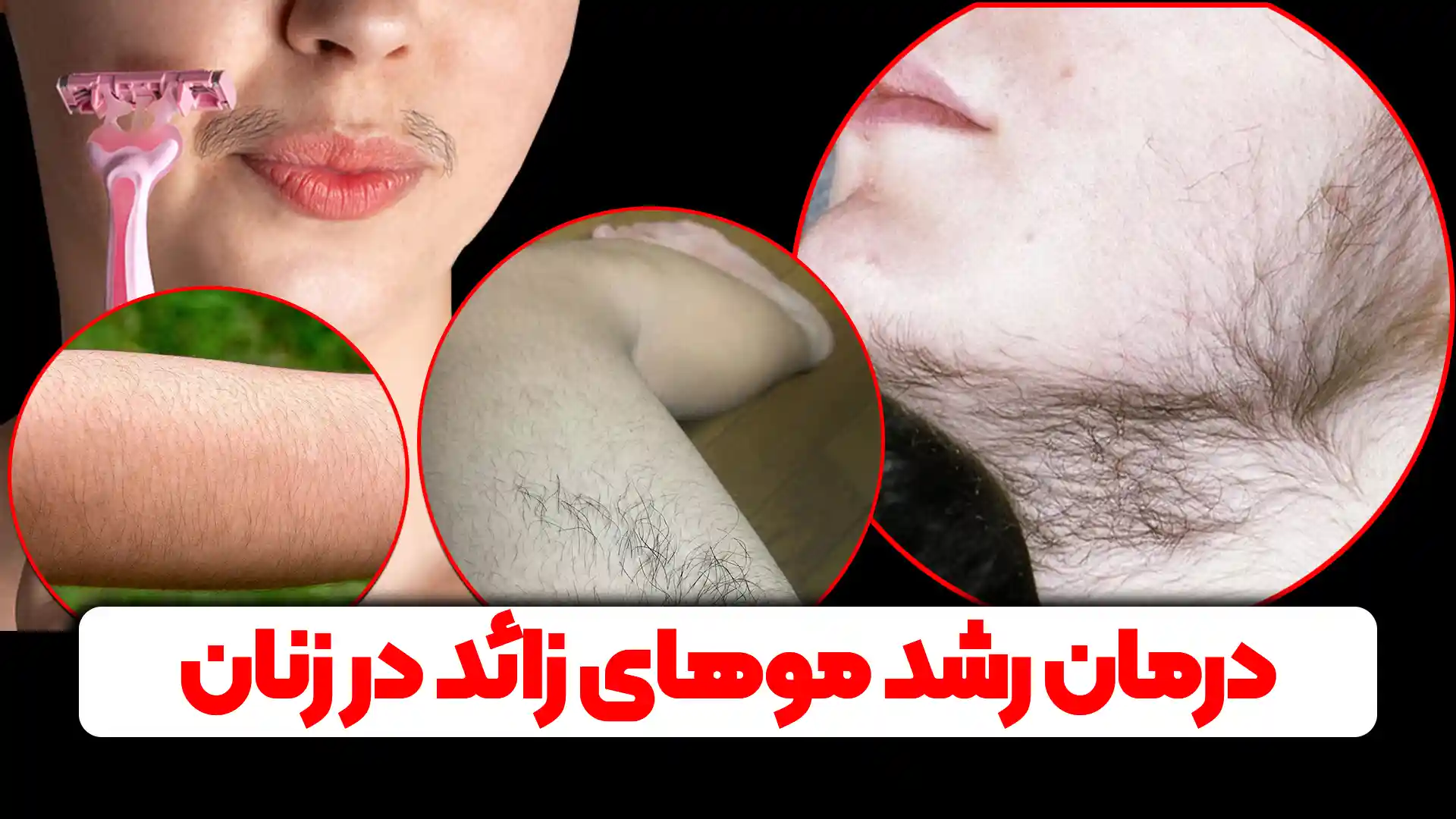 درمان موهای زائد در زنان